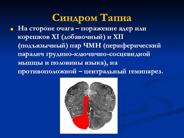 Синдром Тапиа На стороне очага – поражение ядер или корешков