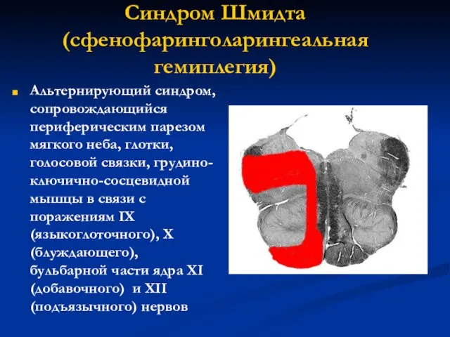 Синдром Шмидта (сфенофаринголарингеальная гемиплегия) Альтернирующий синдром, сопровождающийся периферическим парезом мягкого