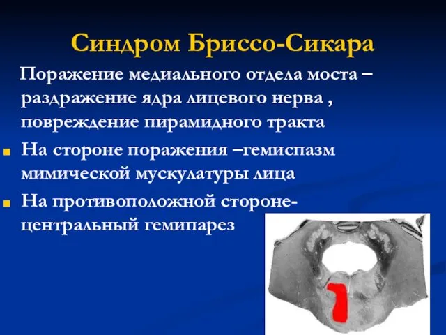 Синдром Бриссо-Сикара Поражение медиального отдела моста – раздражение ядра лицевого