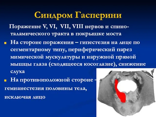 Синдром Гасперини Поражение V, VI, VII, VIII нервов и спино-таламического