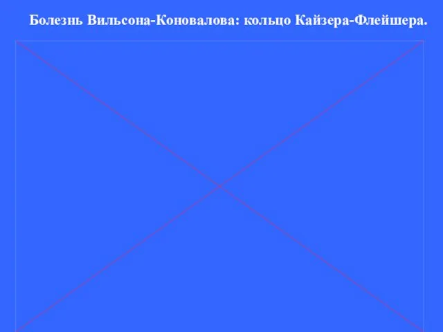 Болезнь Вильсона-Коновалова: кольцо Кайзера-Флейшера.