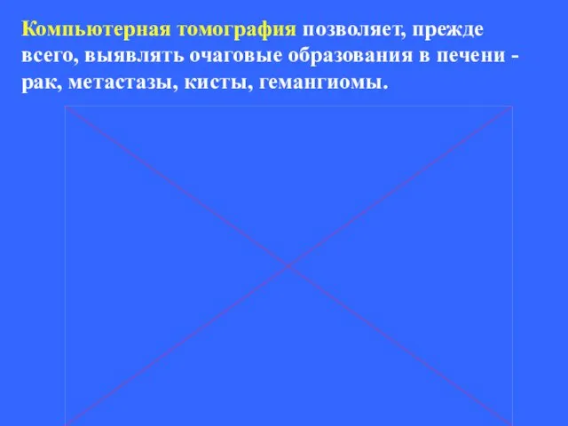 Компьютерная томография позволяет, прежде всего, выявлять очаговые образования в печени - рак, метастазы, кисты, гемангиомы.