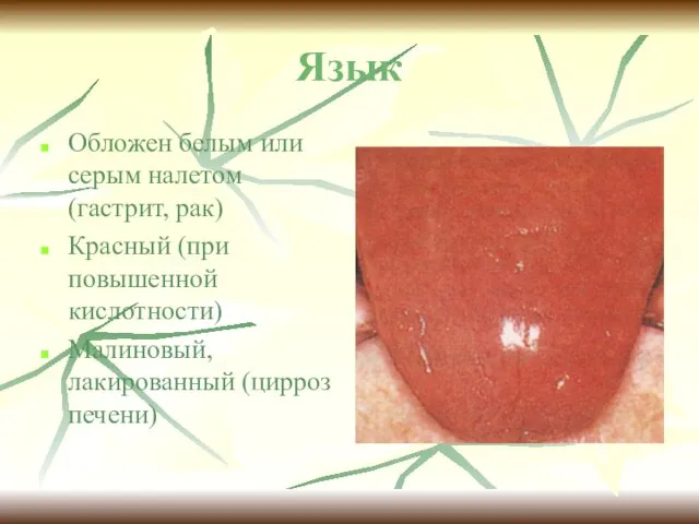 Язык Обложен белым или серым налетом (гастрит, рак) Красный (при повышенной кислотности) Малиновый, лакированный (цирроз печени)