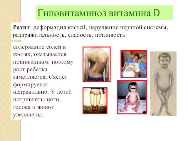 Рахит- деформация костей, нарушение нервной системы, раздражительность, слабость, потливость содержание