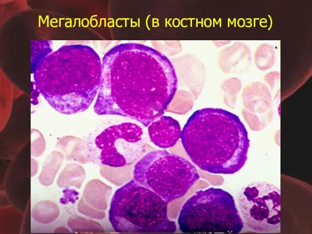 Мегалобласты (в костном мозге)