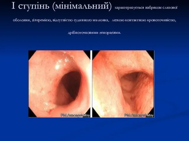 I ступінь (мінімальний) характеризується набряком слизової оболонки, гіперемією, відсутністю судинного малюнка, легкою контактною кровоточивістю, дрібноточковими геморагіями.