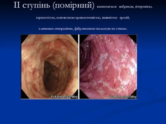 II ступінь (помірний) визначається набряком, гіперемією, зернистістю, контактною кровоточивістю, наявністю