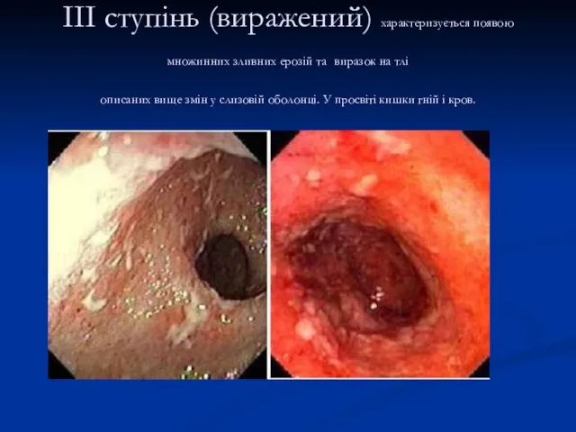 III ступінь (виражений) характеризується появою множинних зливних ерозій та виразок