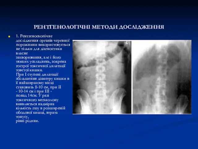 РЕНТГЕНОЛОГІЧНІ МЕТОДИ ДОСЛІДЖЕННЯ 1. Рентгеноскопічне дослідження органів черевної порожнини використовується