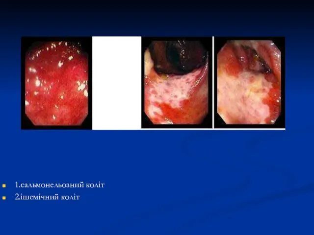 1.сальмонельозний коліт 2.ішемічний коліт