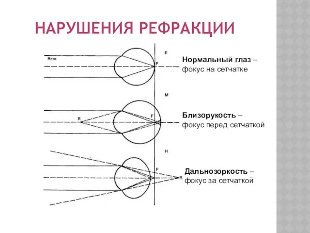 НАРУШЕНИЯ РЕФРАКЦИИ Нормальный глаз – фокус на сетчатке Близорукость –