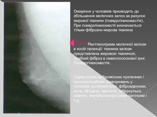 Ожиріння у чоловіків призводить до збільшення молочних залоз за рахунок