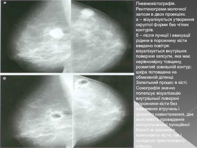 Пневмокістографія. Рентгенограми молочної залози в двох проекціях. а – візуалізується