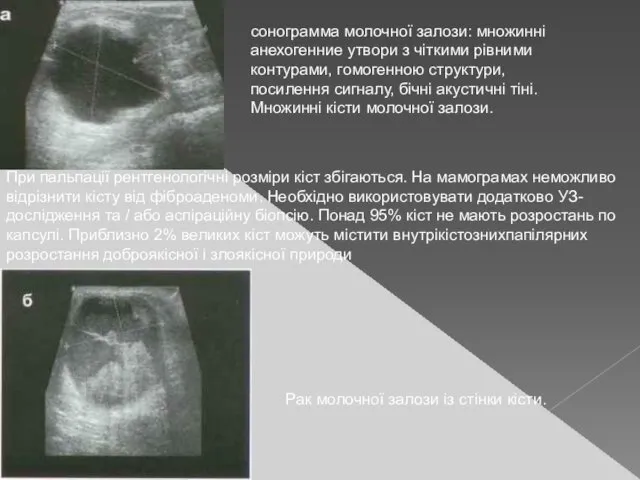 При пальпації рентгенологічні розміри кіст збігаються. На мамограмах неможливо відрізнити