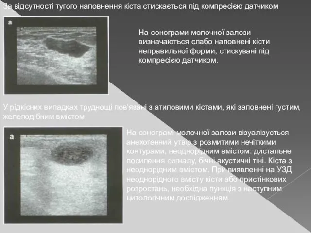 За відсутності тугого наповнення кіста стискається під компресією датчиком На