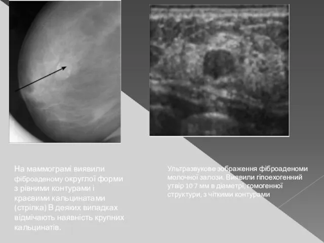 На маммограмі виявили фіброаденому округлої форми з рівними контурами і