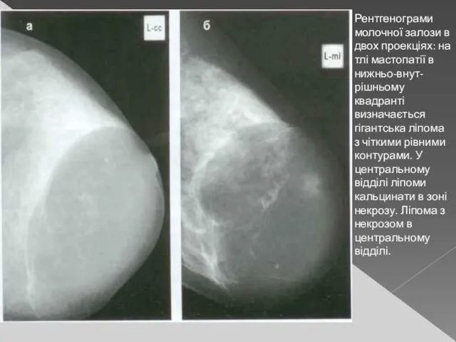 Рентгенограми молочної залози в двох проекціях: на тлі мастопатії в