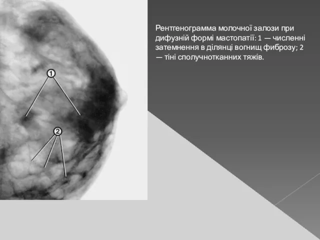 Рентгенограмма молочної залози при дифузній формі мастопатії: 1 — численні