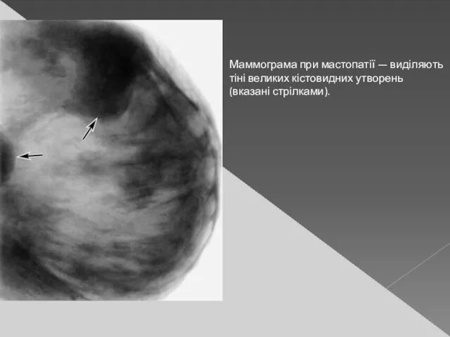 Маммограма при мастопатії — виділяють тіні великих кістовидних утворень (вказані стрілками).