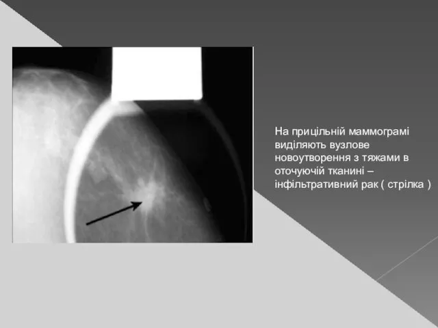 На прицільній маммограмі виділяють вузлове новоутворення з тяжами в оточуючій