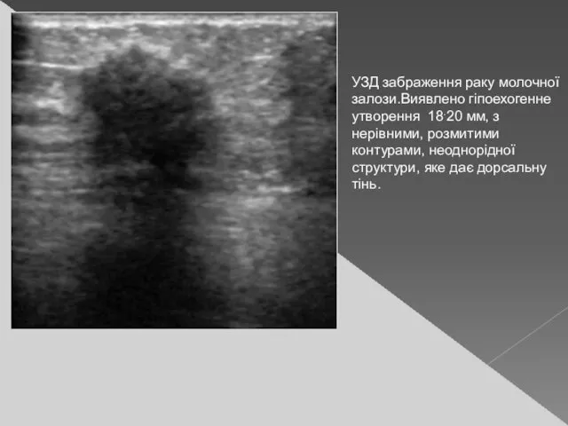 УЗД забраження раку молочної залози.Виявлено гіпоехогенне утворення 18.20 мм, з