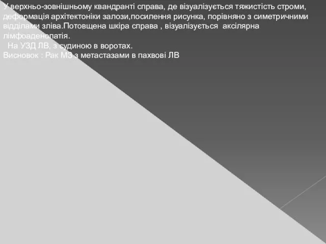 У верхньо-зовнішньому квандранті справа, де візуалізується тяжистість строми, деформація архітектоніки