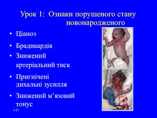 1- Урок 1: Ознаки порушеного стану новонародженого Ціаноз Брадикардія Знижений