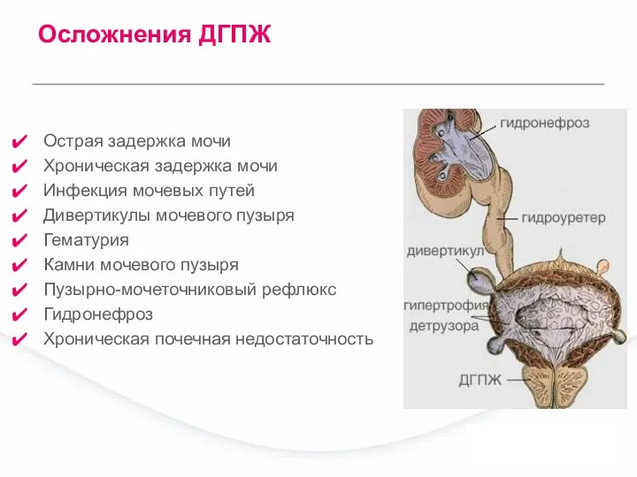 Осложнения ДГПЖ Острая задержка мочи Хроническая задержка мочи Инфекция мочевых