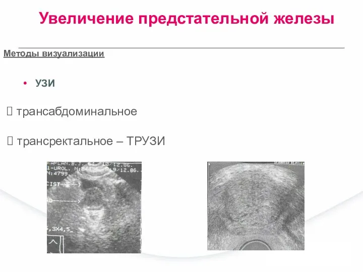 УЗИ трансабдоминальное Методы визуализации трансректальное – ТРУЗИ Увеличение предстательной железы