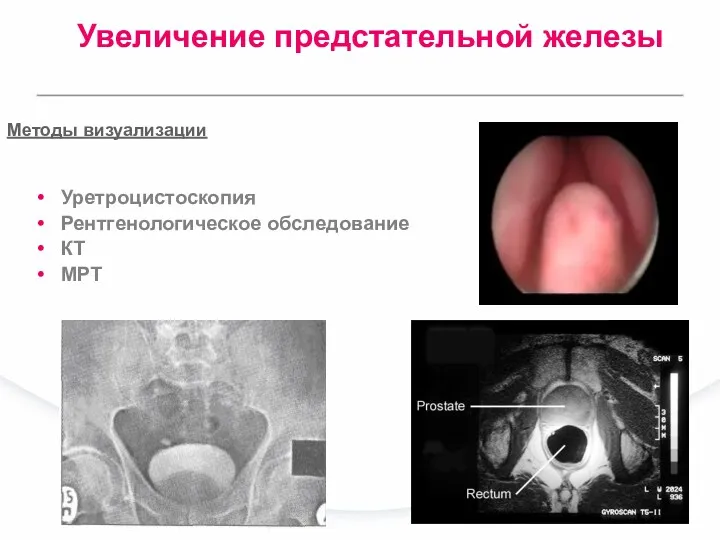 Методы визуализации Уретроцистоскопия Рентгенологическое обследование КТ МРТ Увеличение предстательной железы