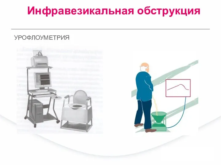 УРОФЛОУМЕТРИЯ Инфравезикальная обструкция