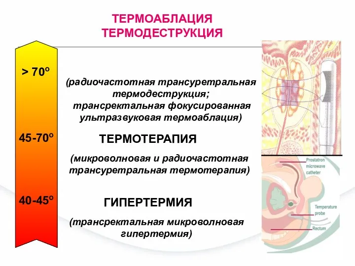 40-45о 45-70о > 70о ГИПЕРТЕРМИЯ (трансректальная микроволновая гипертермия) ТЕРМОТЕРАПИЯ (микроволновая