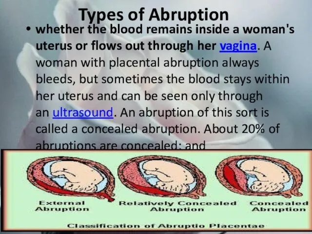 Types of Abruption whether the blood remains inside a woman's uterus or flows