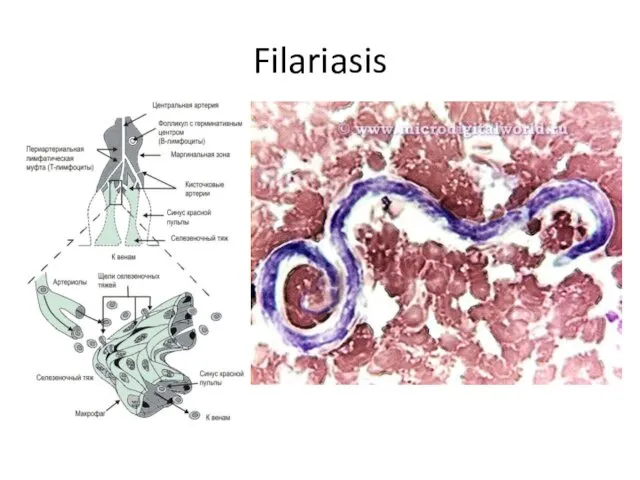 Filariasis