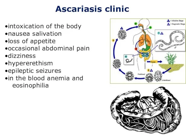 Ascariasis clinic intoxication of the body nausea salivation loss of appetite occasional abdominal
