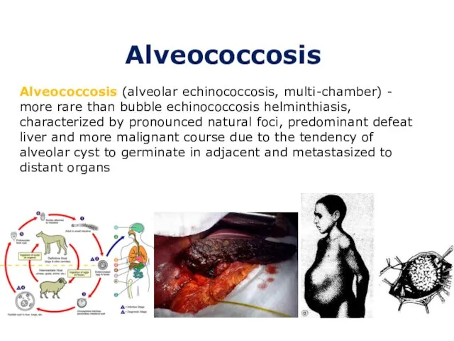 Alveococcosis Alveococcosis (alveolar echinococcosis, multi-chamber) - more rare than bubble echinococcosis helminthiasis, characterized