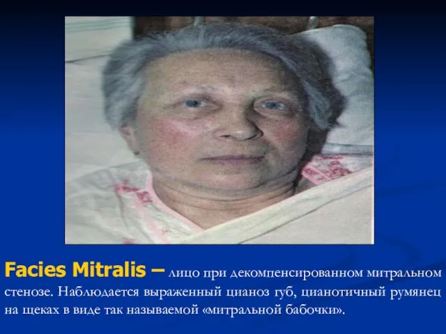 Facies Mitralis – лицо при декомпенсированном митральном стенозе. Наблюдается выраженный