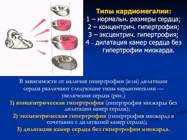 В зависимости от наличия гипертрофии (или) дилатации сердца различают следующие