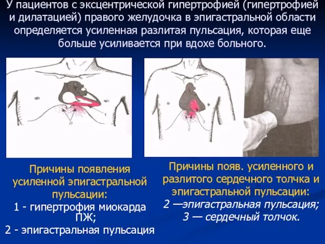 У пациентов с эксцентрической гипертрофией (гипертрофией и дилатацией) правого желудочка