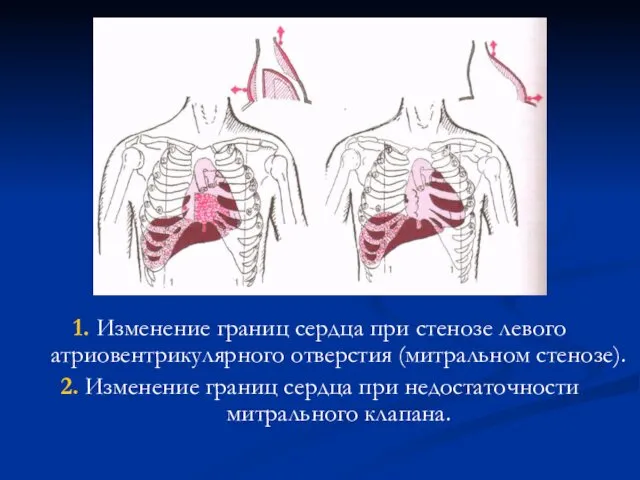 1. Изменение границ сердца при стенозе левого атриовентрикулярного отверстия (митральном