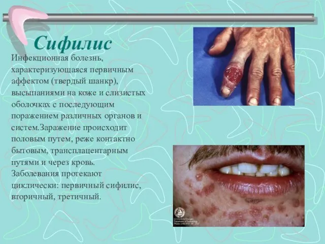 Сифилис Инфекционная болезнь, характеризующаяся первичным аффектом (твердый шанкр), высыпаниями на коже и слизистых