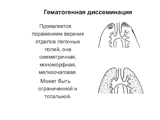 Гематогенная диссеминация Проявляется поражением верхних отделов легочных полей, она симметричная,