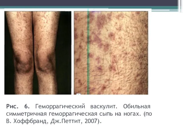 Рис. 6. Геморрагический васкулит. Обильная симметричная геморрагическая сыпь на ногах. (по В. Хоффбранд, Дж.Петтит, 2007).