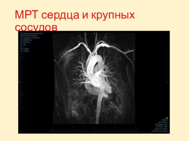 МРТ сердца и крупных сосудов