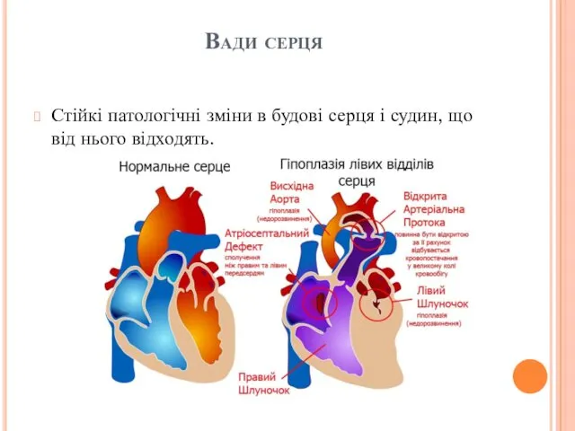 Вади серця Стійкі патологічні зміни в будові серця і судин, що від нього відходять.