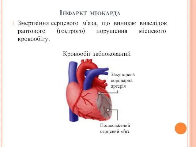 Інфаркт міокарда Змертвіння серцевого м’яза, що виникає внаслідок раптового (гострого) порушення місцевого кровообігу.