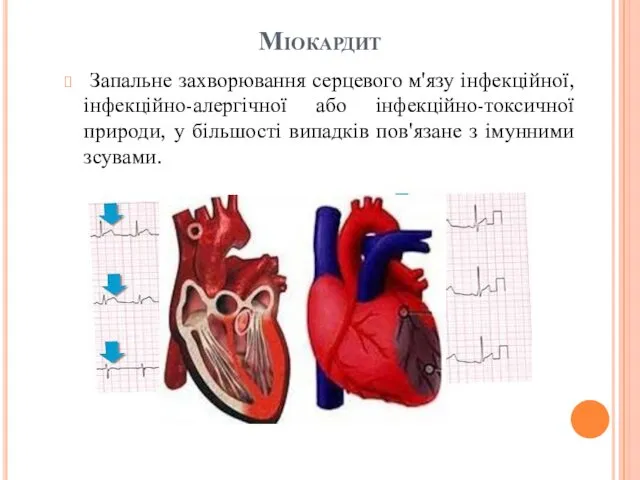 Міокардит Запальне захворювання серцевого м'язу інфекційної, інфекційно-алергічної або інфекційно-токсичної природи,