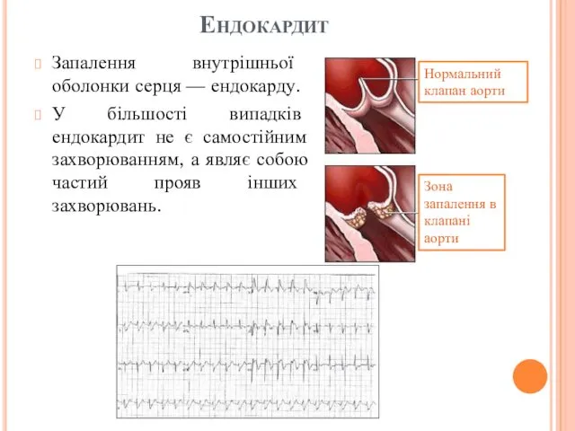 Ендокардит Запалення внутрішньої оболонки серця — ендокарду. У більшості випадків