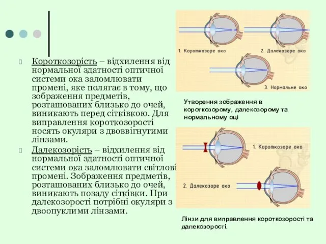 Короткозорість – відхилення від нормальної здатності оптичної системи ока заломлювати