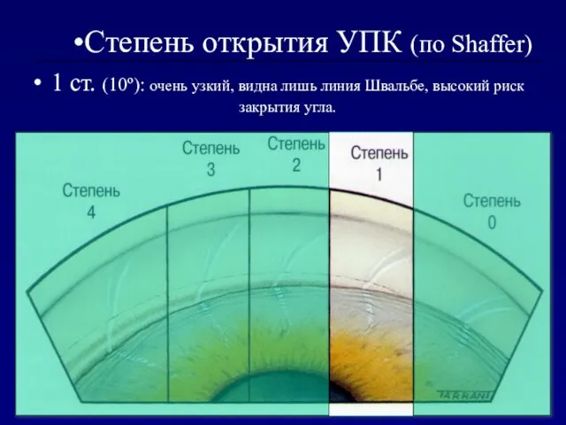 1 ст. (10º): очень узкий, видна лишь линия Швальбе, высокий